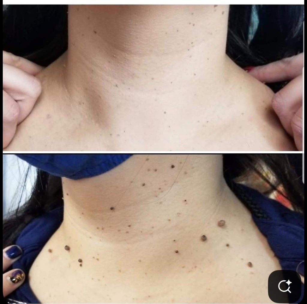 Laser Mole Removal Treatment Result