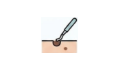 Mole Removal